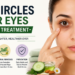 Dark Circles Under Eyes Causes and Treatment