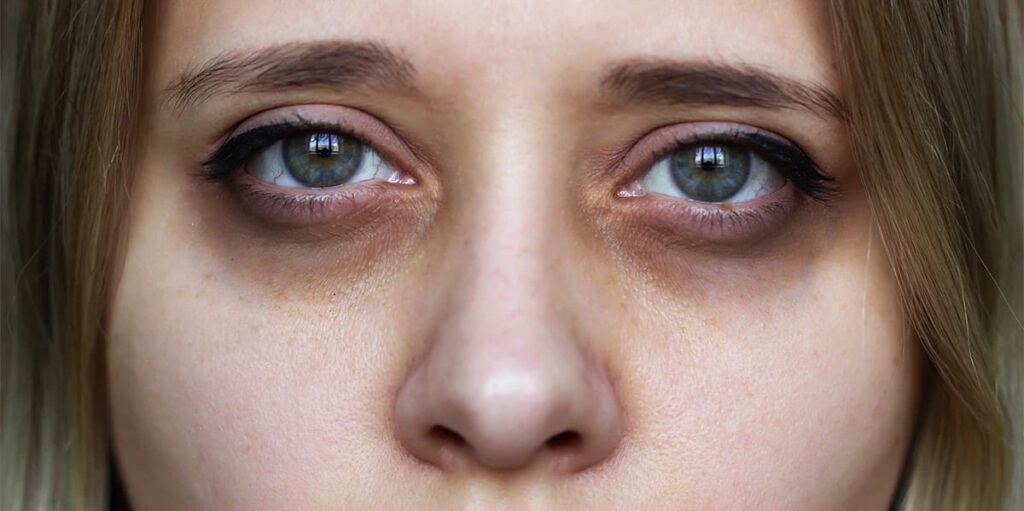 Dark Circles Under Eyes Causes and Treatment
