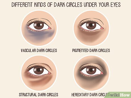 Dark Circle Remedy You Need: Natural Under-Eye Care with Coffee, Turmeric, Potato Juice & Honey Dark Circle Remedy